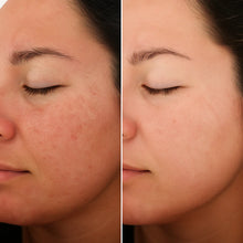 Porephil™ – Zero Pore Cleanser