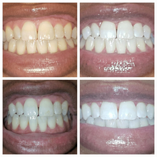 Smyle™ - Teeth Whitening Pen